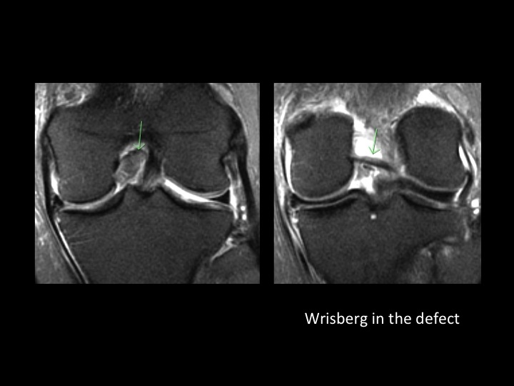Figure 2 for case posterior cruciate ligament ( RID2784 )